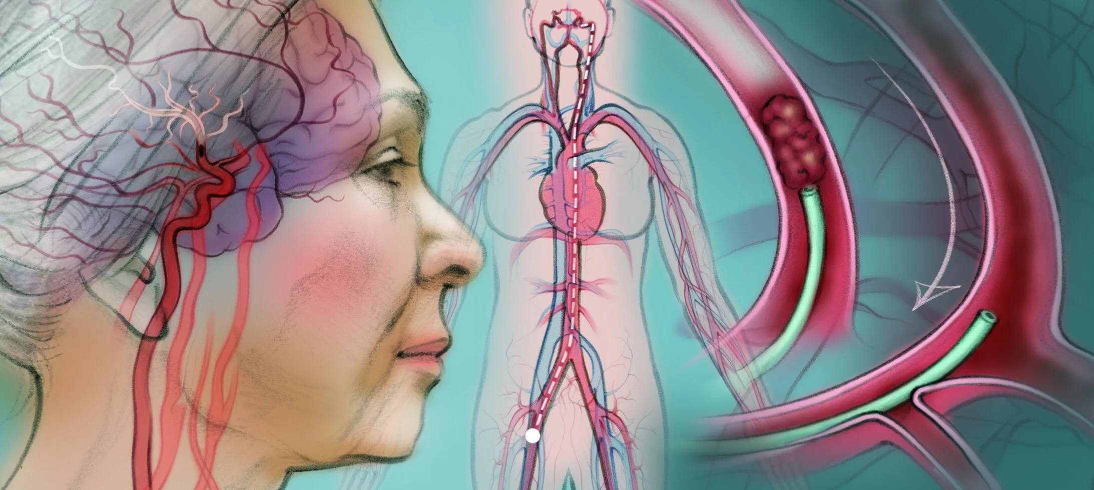 نجات مغز با ترمبکتومی