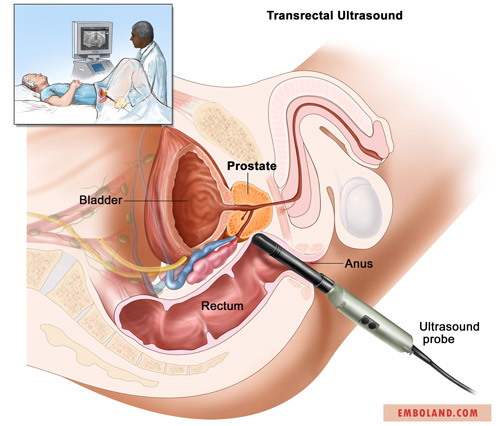 روش آمبولیزاسیون پروستات (PAE) در درمان هیپرپلازی خوش‌خیم پروستات