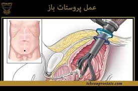 روش آمبولیزاسیون پروستات (PAE) در درمان هیپرپلازی خوش‌خیم پروستات