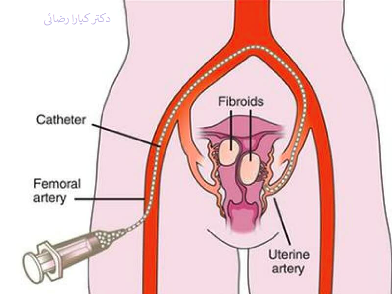 آمبولیزاسیون پروستات