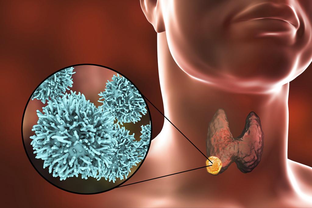 ندول تیروئید