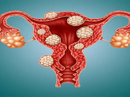 درمان نوین فیبروم رحمی