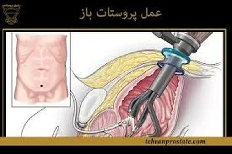 روش آمبولیزاسیون پروستات (PAE) در درمان هیپرپلازی خوشخیم پروستات: شواهد علمی و تجربیات بینالمللی